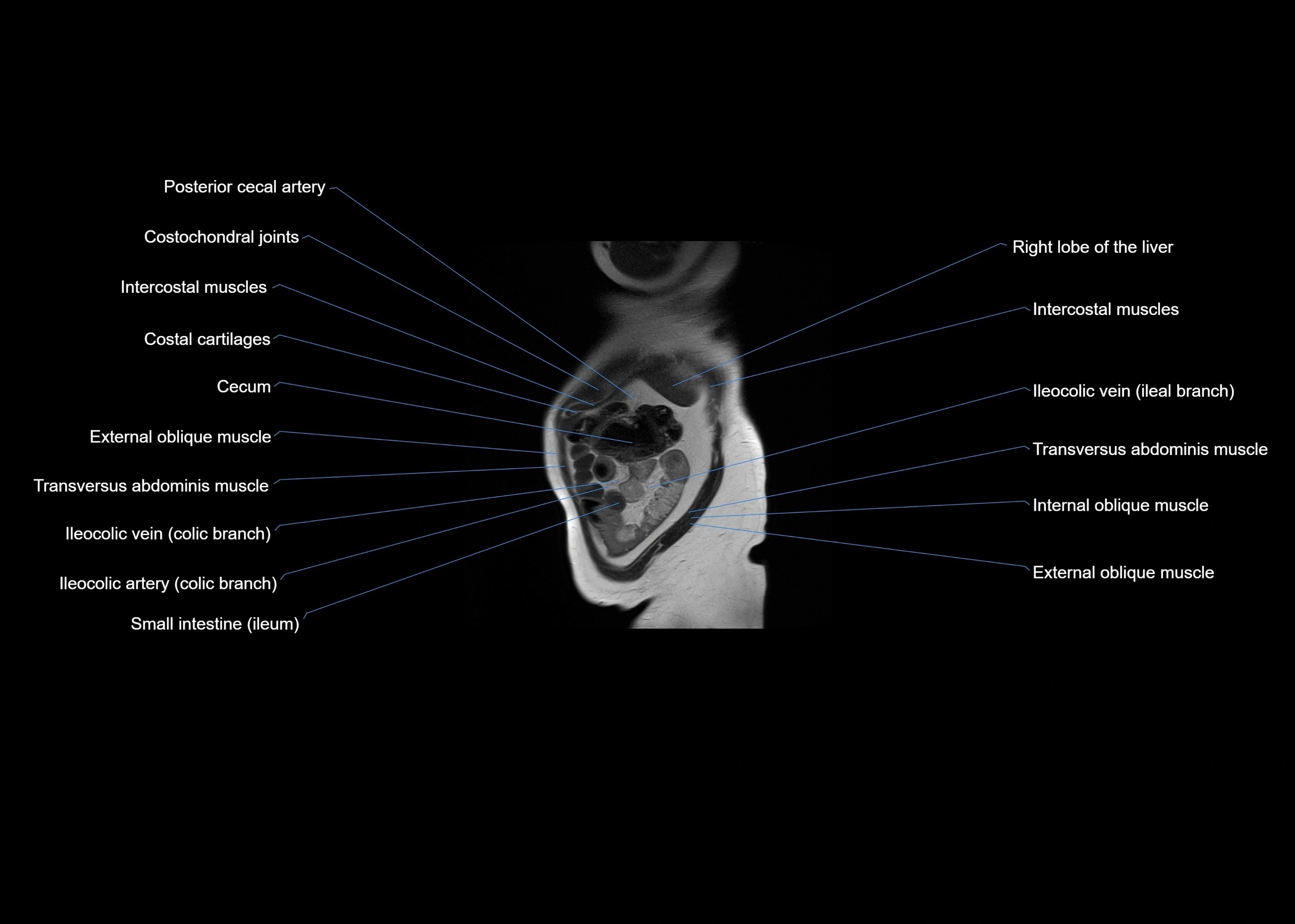 MRI abdomen sagittal cross sectional anatomy  radiology  image-img-00001-00008.webp